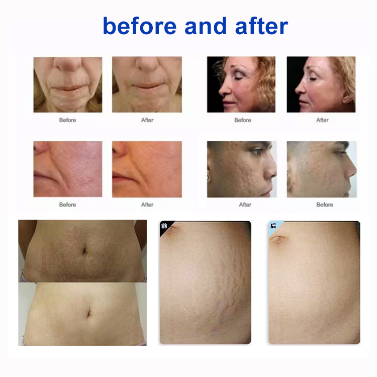 RF-Fractional-Microneedling-Mesin-Wrinkle-Removal-Raray-Angkat-Anti-Aging-Stretch-marks-Remover-Anti-Jerawat-Microneedle4