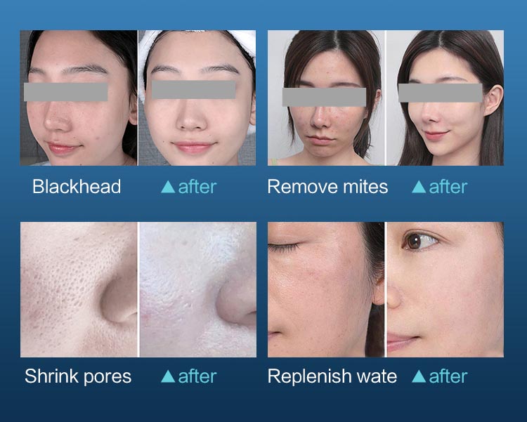 جهاز تقشير الوجه بالأكسجين-الماء النفاث-جهاز-هيدرافيشل-تنظيف الوجه-الرؤوس السوداء4