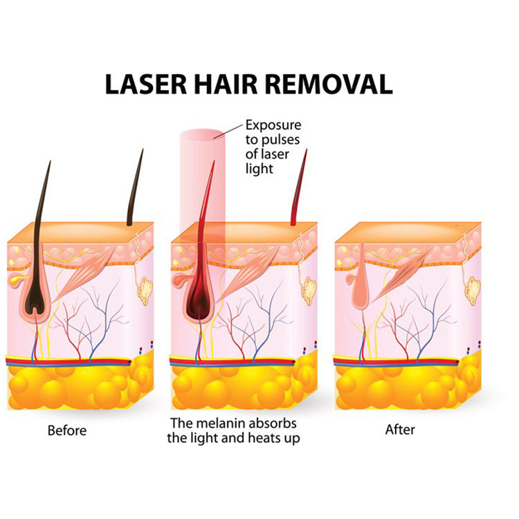 diode-laser-hair-removal-legs-butt-underarms-bikini-area-facial-medspa9