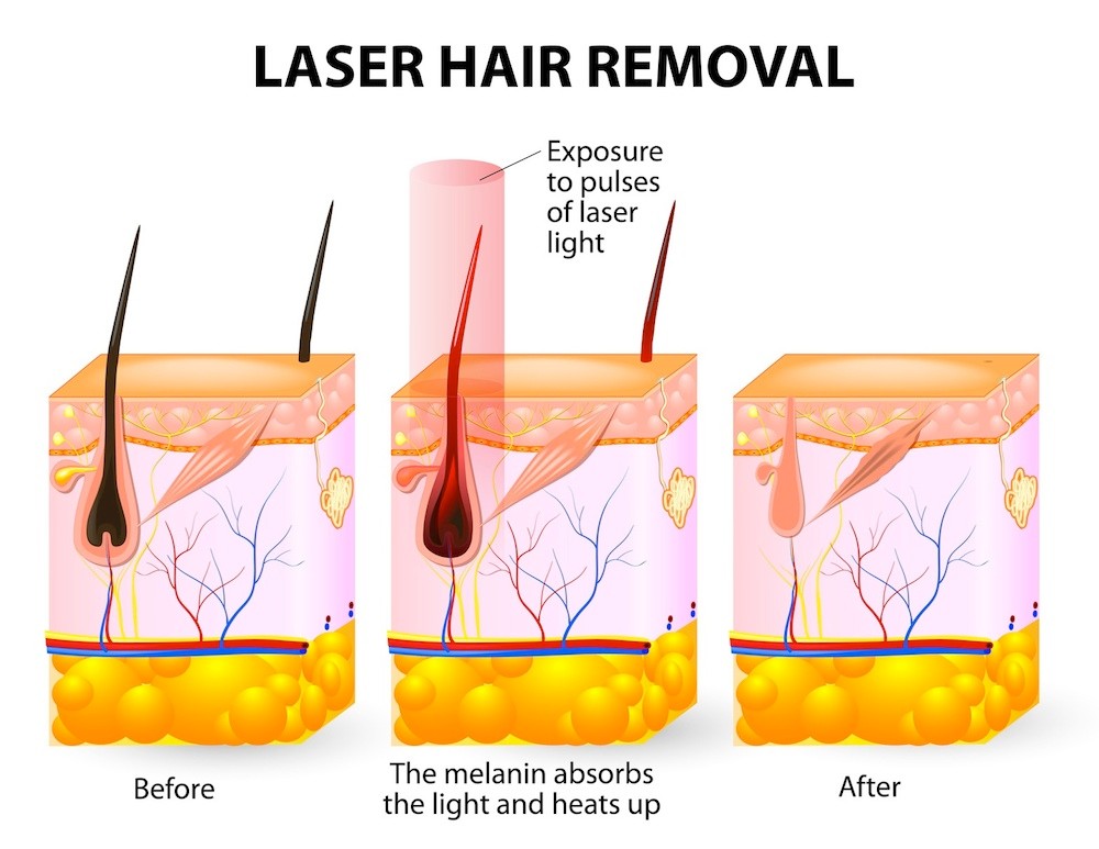 The laser emits an invisible light which penetrates the skin without damaging it. At the hair follicle, the laser light absorbed by the pigments is converted into heat. This heat will damage the follicle.