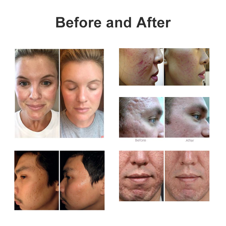 Wrinkles-Microneedling-Before-and-After-Picture1