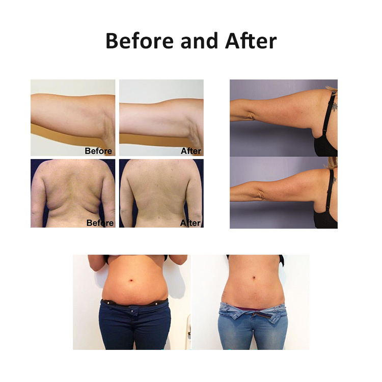 fat_freezing_cryolipolysis_slimming_machine_before_and_after